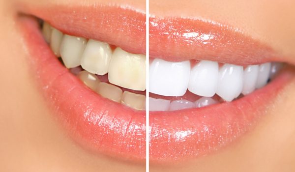 clareamento-dental-dentista-em-londrina