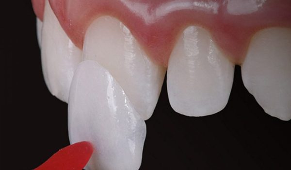 faceta-de-resina-ou-lente-de-contato-dental-diferenca-qual-e-melhor-1038x576-1.jpg