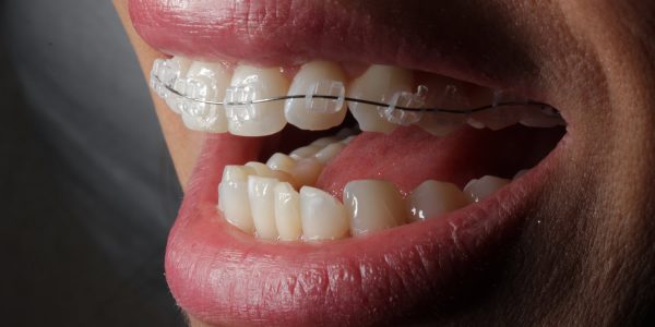 ortodontia-corretiva